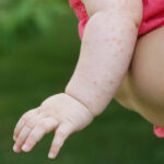 romania a avut peste 1 000 de cazuri de rujeola in luna mai judetul cu cele mai multe imbolnaviri 683ffdab2dcae