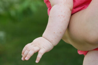 romania a avut peste 1 000 de cazuri de rujeola in luna mai judetul cu cele mai multe imbolnaviri 683ffdab2dcae