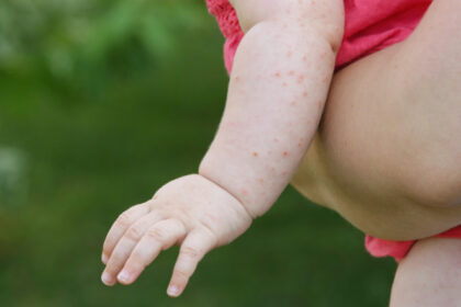 romania a avut peste 1 000 de cazuri de rujeola in luna mai judetul cu cele mai multe imbolnaviri 683ffdab2dcae