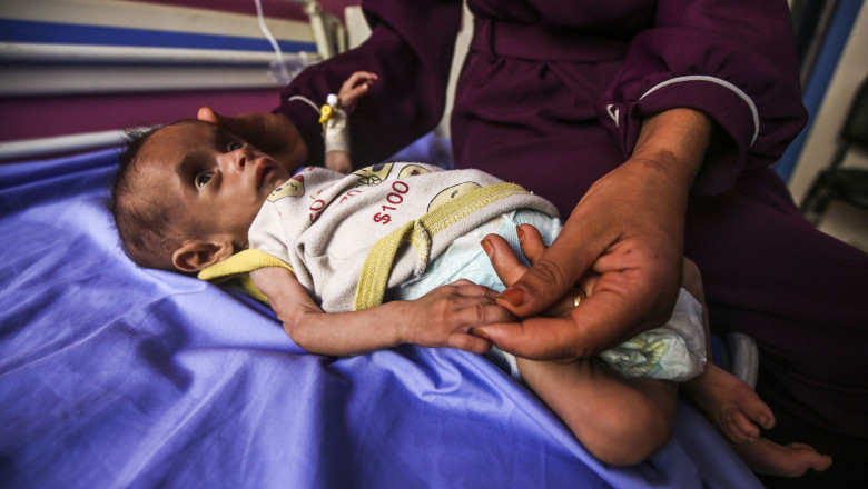 galerie foto infometare in masa numarul copiilor subnutriti din gaza cu varste sub 5 ani s a triplat in ultimele doua saptamani 6883ef2f97ae5