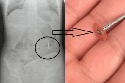 un dentist din iasi a scapat in gura unui copil de 5 ani un dispozitiv metalic iar acesta a inghitit o ce va agitati n a murit plangea mai tare pentru ca tipa mama 686dbb5fdc8dc