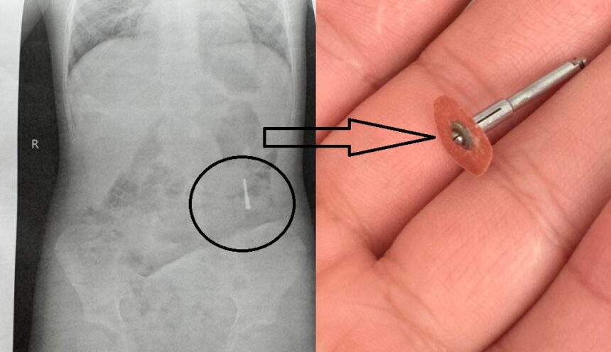 un dentist din iasi a scapat in gura unui copil de 5 ani un dispozitiv metalic iar acesta a inghitit o ce va agitati n a murit plangea mai tare pentru ca tipa mama 686dbb5fdc8dc