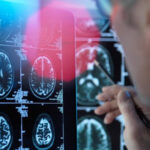 un medicament pentru tratarea bolii alzheimer in stadii timpurii este aproape de autorizare in ue ce este donanemab 68861999c817a