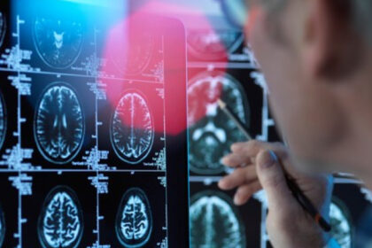 un medicament pentru tratarea bolii alzheimer in stadii timpurii este aproape de autorizare in ue ce este donanemab 68861999c817a