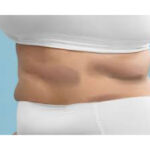 criolipoliza revolutioneaza remodelarea corporala tratament de top pentru rezultate vizibile fara bisturiu 6899dba9075f0