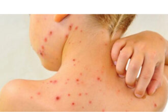 rujeola loveste din nou cu peste 300 de cazuri intr o singura luna romania la un pas de un nou varf epidemic 68933ccc8990a