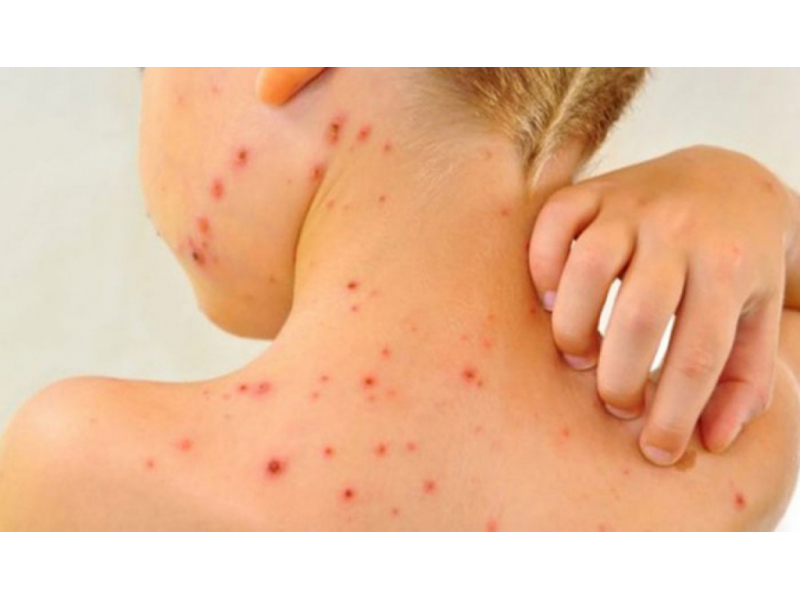 rujeola loveste din nou cu peste 300 de cazuri intr o singura luna romania la un pas de un nou varf epidemic 68933ccc8990a
