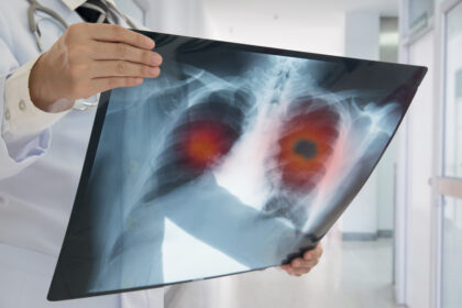 un nou tratament pentru cancerul pulmonar autorizat prin procedura accelerata in sua 689858de7347e