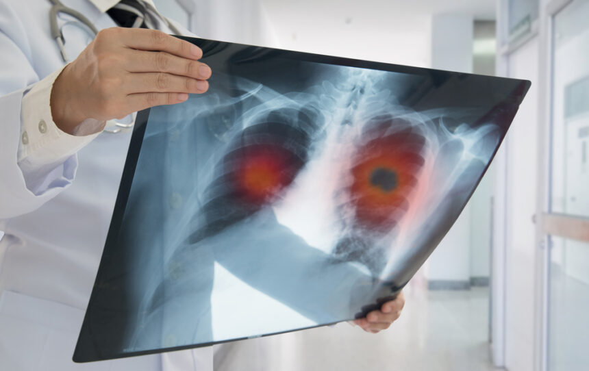 un nou tratament pentru cancerul pulmonar autorizat prin procedura accelerata in sua 689858de7347e