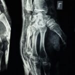 a fost descoperit adezivul care lipeste oasele in doar doua minute lipiciul promite sa schimbe ortopedia din temelii 68cbc9e48e6b8