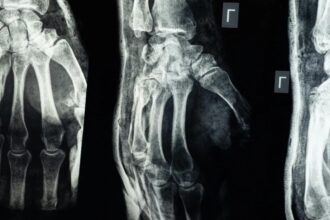 a fost descoperit adezivul care lipeste oasele in doar doua minute lipiciul promite sa schimbe ortopedia din temelii 68cbc9e48e6b8