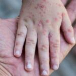 caz neasteptat un copil a murit la cativa ani dupa ce s a vindecat de rujeola afectiunea sspe care i a adus sfarsitul 68cbb26842a24