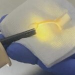 situatie neobisnuita la spitalul de pneumoftiziologie din iasi un pacient s a prezentat la unitatea medicala dupa ce inghitit jumatate de unghiera 68b7869cd2a39