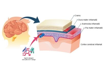 meningita 68ff00b3c7fdd
