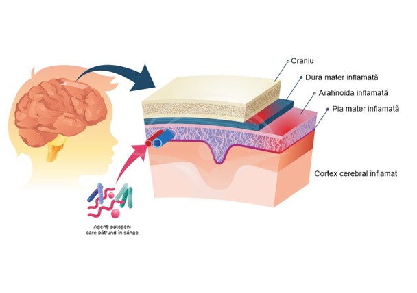 meningita 68ff00b3c7fdd
