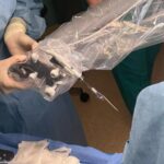 prima implantare cohleara asistata robotic in romania realizata la iasi 69032d74d2e0f