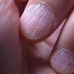 semnele de pe unghii care indica afectiunile de care suferi ce boli poti avea daca ai pete albe pe unghii 68e742db06b19