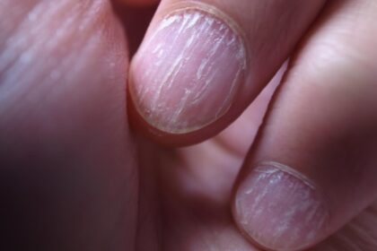 semnele de pe unghii care indica afectiunile de care suferi ce boli poti avea daca ai pete albe pe unghii 68e742db06b19