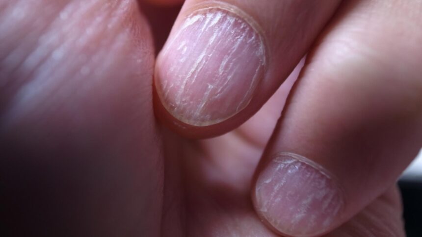 semnele de pe unghii care indica afectiunile de care suferi ce boli poti avea daca ai pete albe pe unghii 68e742db06b19