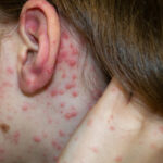 oms avertizeaza asupra reaparitiei rujeolei la nivel global 692aeb9c50ee2