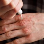 alerta extinsa de lepra la centrul spa din cluj 2 000 de clienti rugati sa mearga la medic 6941910fb30de