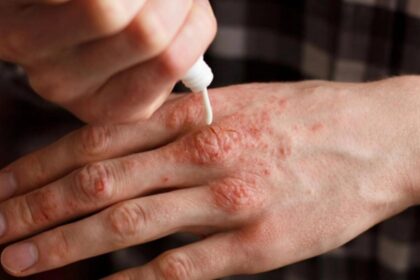 alerta extinsa de lepra la centrul spa din cluj 2 000 de clienti rugati sa mearga la medic 6941910fb30de