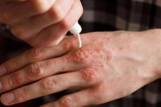 caz de lepra in romania de cate feluri este lepra cum se manifesta si cum se trateaza 693be513a3e72