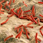 caz rar de lepra confirmat intr o tara din europa autoritatile explica sursa infectarii 693fcf69dce2b