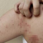 o femeie venita din asia a fost diagnosticata cu lepra in cluj napoca colegele ei de la un salon de masaj sunt evaluate 693b608fce9d5