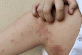 o femeie venita din asia a fost diagnosticata cu lepra in cluj napoca colegele ei de la un salon de masaj sunt evaluate 693b608fce9d5