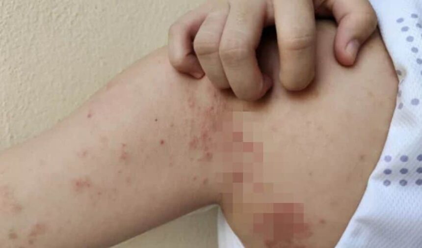 o femeie venita din asia a fost diagnosticata cu lepra in cluj napoca colegele ei de la un salon de masaj sunt evaluate 693b608fce9d5