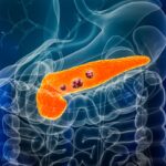 descoperire majora o terapie care combina trei medicamente elimina cancerul pancreatic si previne reaparitia acestuia 697ca5985ff73
