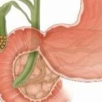 litiaza veziculara cand asteptam cand operam ne explica medicul gabriela canschi 696f13a958b1a