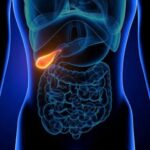 dr gabriela canschi pietrele la fiereo afectiune tacuta cu complicatii zgomotoase 69a915a581f75