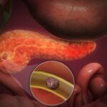 nu numai pietrele la fiere pot crea probleme medicul chirurg gabriela canschi va explica de ce 69c2295a107ea