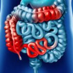 ce reprezinta bolile inflamatorii intestinale dr gabriela canschi ne explica 6a0c123dc0d52