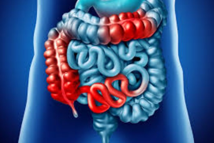 ce reprezinta bolile inflamatorii intestinale dr gabriela canschi ne